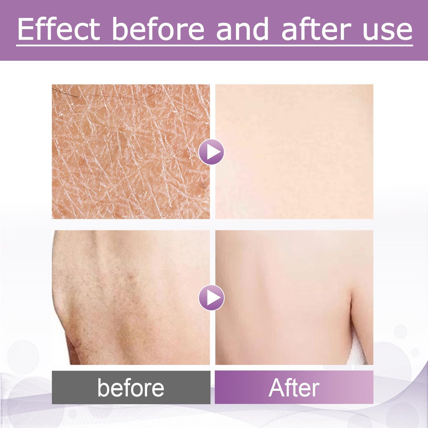 Repair Chicken Skin Body Scrub Keratosis Pilaris Lotion ffor Strawberry Legs Dark Spot Removal KP Bump Smooth Lotion Skin Care