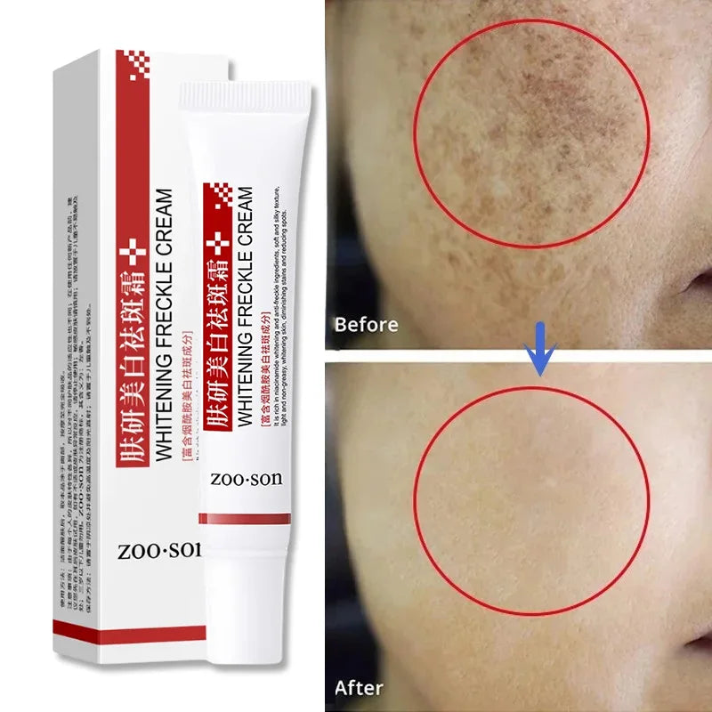 Effective Whitening Freckle Cream Anti-pigmentation Nourishing Fast Remove Melasma Dark Spot Fade Melanin Face Care Cream