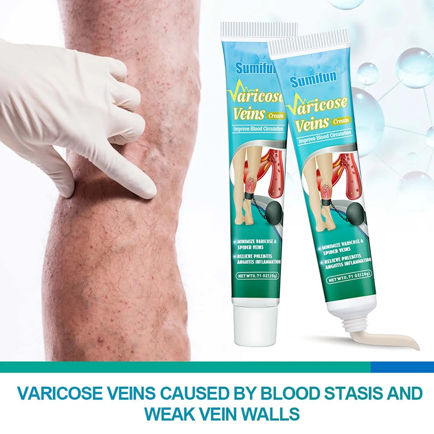 Varicose Vein Relief ,Improve Blood Circulations Spider Varicose Vein For Tired Heavy Legs Fast Relief Partijbenodigdheden