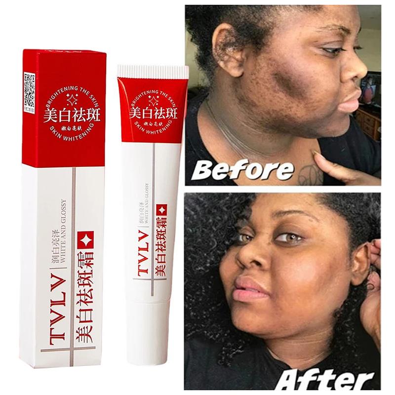 Whitening Freckle Cream Melasma Dark Spots Pigmentation Removal Products Fade Stain Melanin Repair Brighten Korean Skin Care