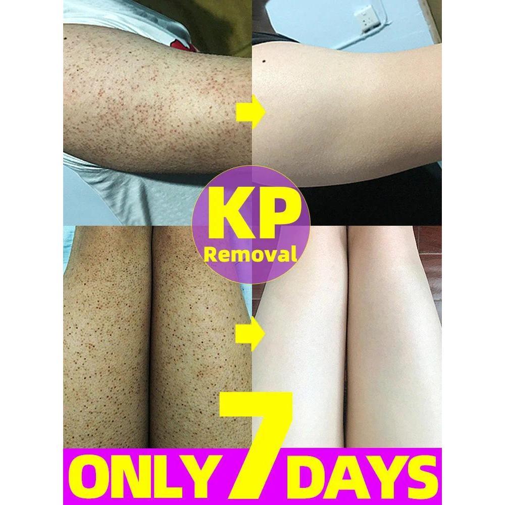 Sale!! 7-Day Fast Body Scrub Cream Moisturizing Skin Repair Keratosis Pilaris Removing Strawberry Legs Eraser Nourishing Body Skin Care