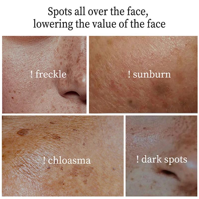 Whitening Freckle Cream Melasma Dark Spots Pigmentation Removal Products Fade Stain Melanin Repair Brighten Korean Skin Care