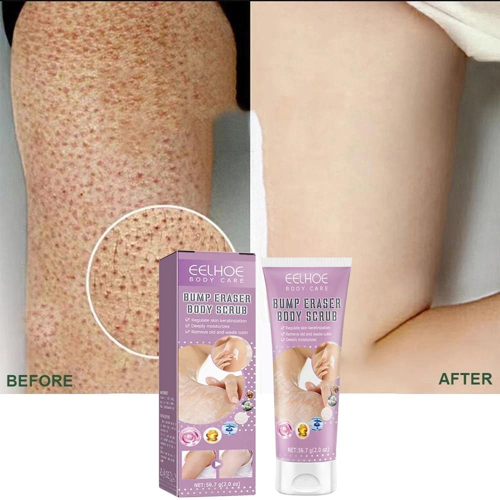 Sale!! 7-Day Fast Body Scrub Cream Moisturizing Skin Repair Keratosis Pilaris Removing Strawberry Legs Eraser Nourishing Body Skin Care