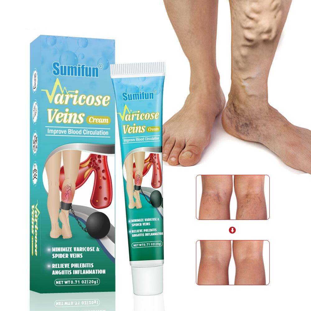 3 Pack Varicose Veins Cream, Soothing Leg Cream with Natural Ingredients Improve Blood Circulation,Relieve Pain of Legs