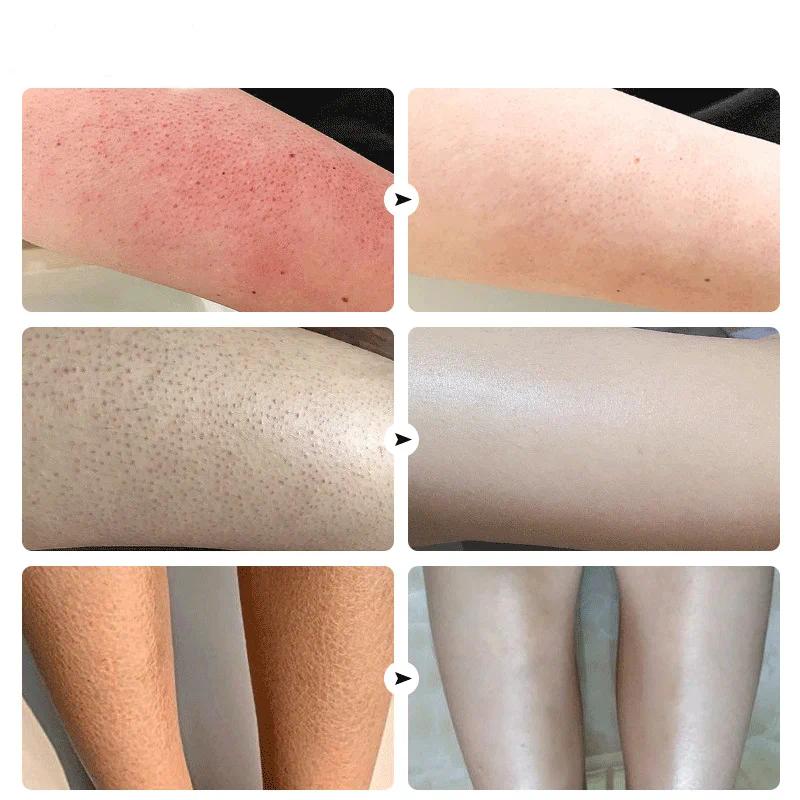 Sale!! 7-Day Fast Body Scrub Cream Moisturizing Skin Repair Keratosis Pilaris Removing Strawberry Legs Eraser Nourishing Body Skin Care