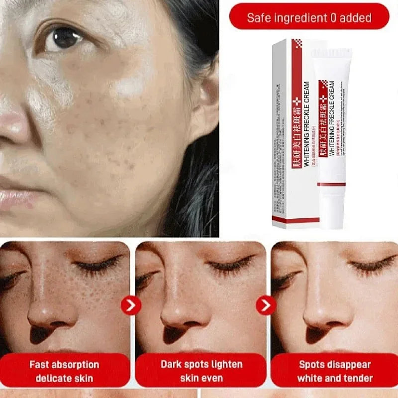 Effective Freckle Cream Fast Brighten Face Remove Melasma Dark Spot Fade Melanin Whiten Anti-pigmentation Improve Dullness