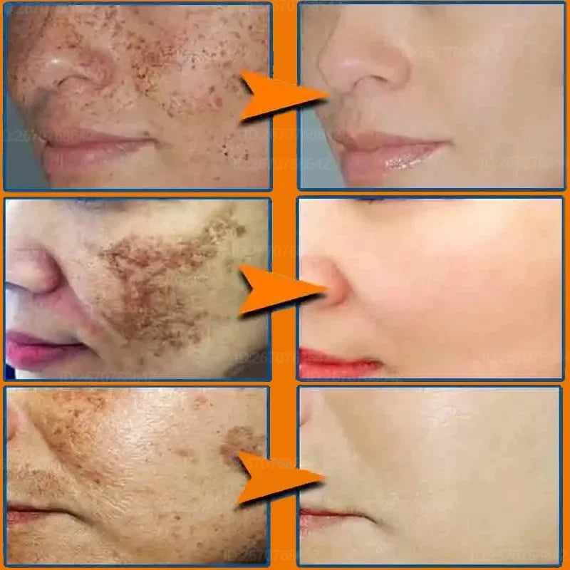 Effective Freckle Cream Fast Brighten Face Remove Melasma Dark Spot Fade Melanin Whiten Anti-pigmentation Improve Dullness
