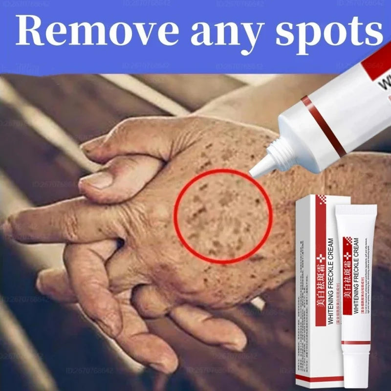 Effective Freckle Cream Fast Brighten Face Remove Melasma Dark Spot Fade Melanin Whiten Anti-pigmentation Improve Dullness