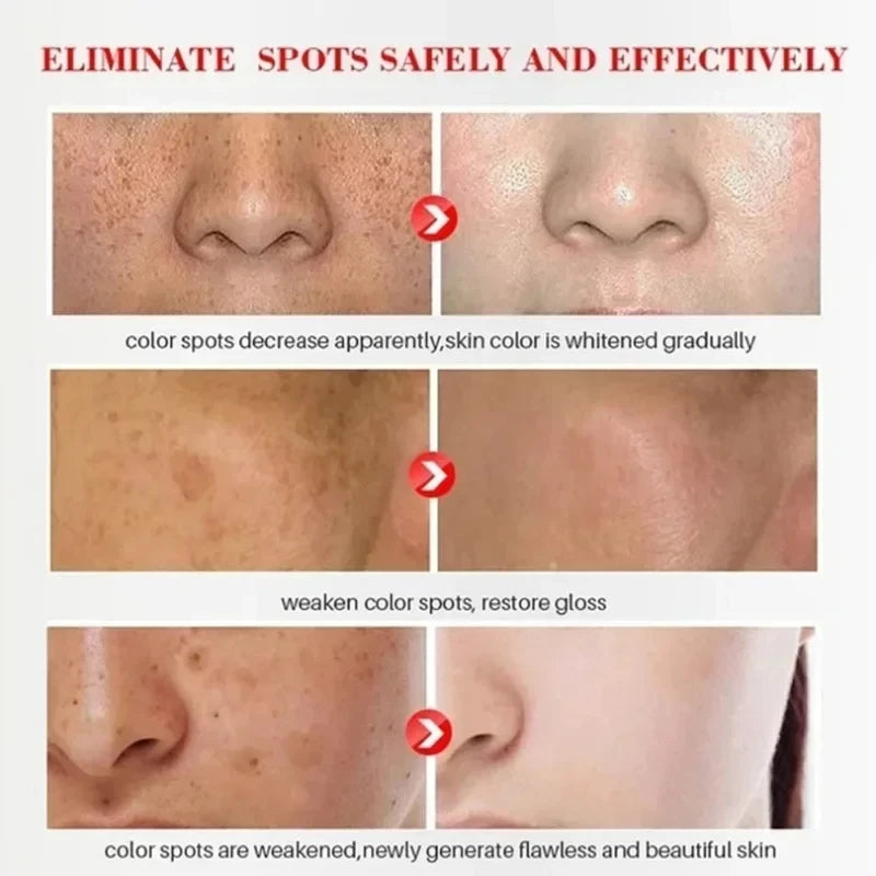 Effective Whitening Freckle Cream Anti-pigmentation Nourishing Fast Remove Melasma Dark Spot Fade Melanin Face Care Cream