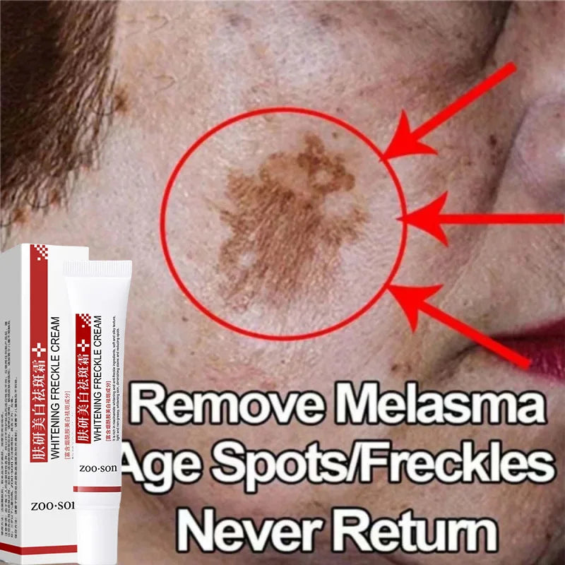 Face Freckle Cream Effective Remove Dark Spot Melasma Fade Melanin Anti-pigmentation Improve Dullness Whiten Skin Care Products