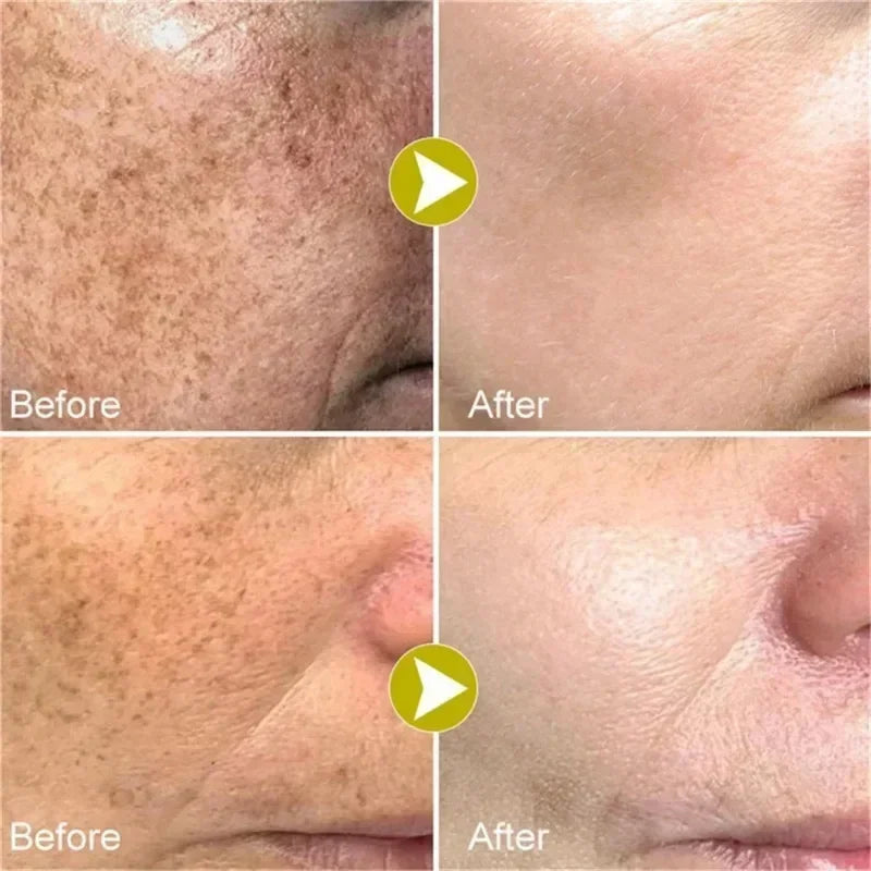 Face Melasma Cream Brightening Dark Skin Remove Black Dots Lightening Melanin Brighten Cream For Dull Skin  Moisturizing Product