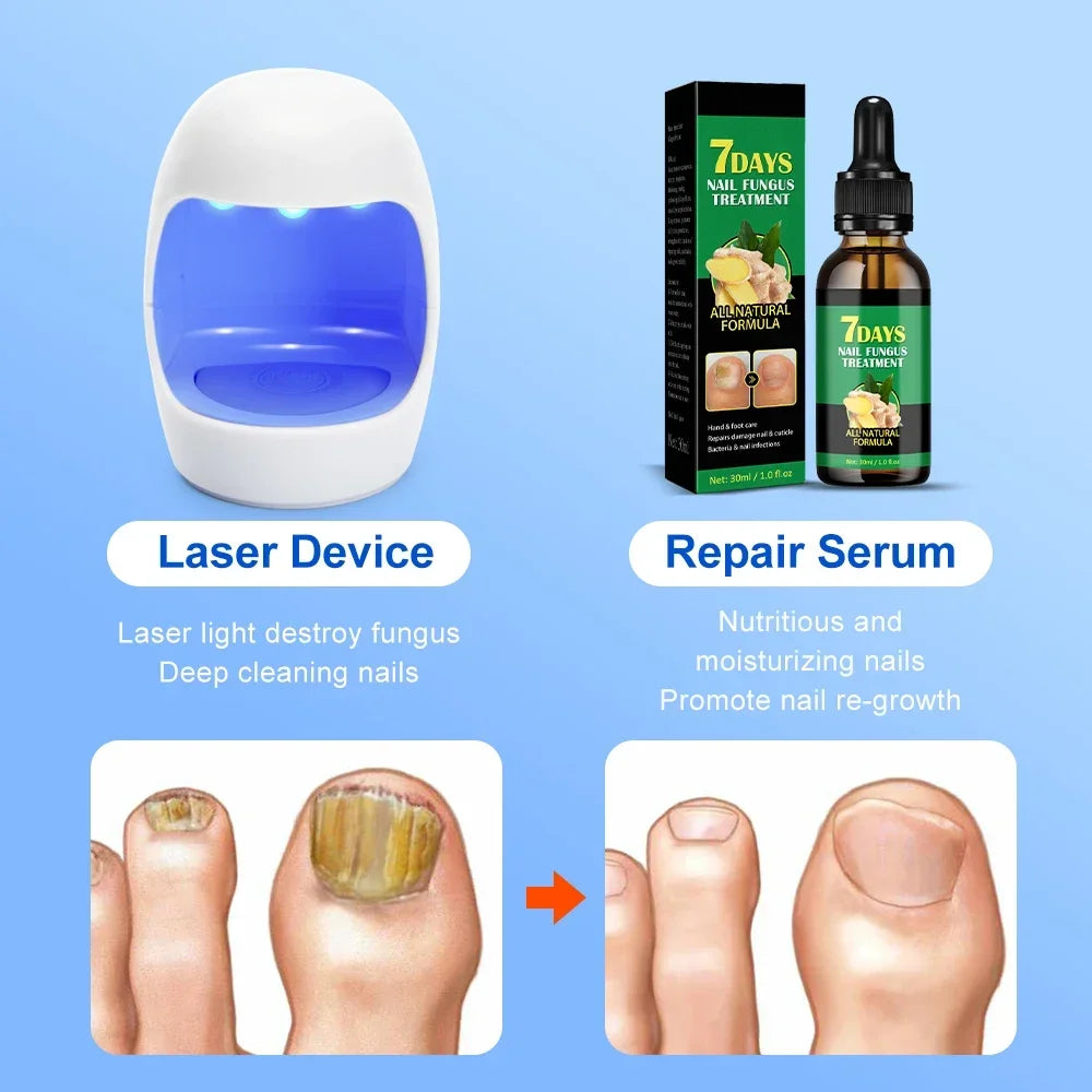Fungal Nail Laser Device Repair Fast Onychomycosis Fungus Nails Toenail for Foot Nail Fungus Essential Oil Nail Treatment