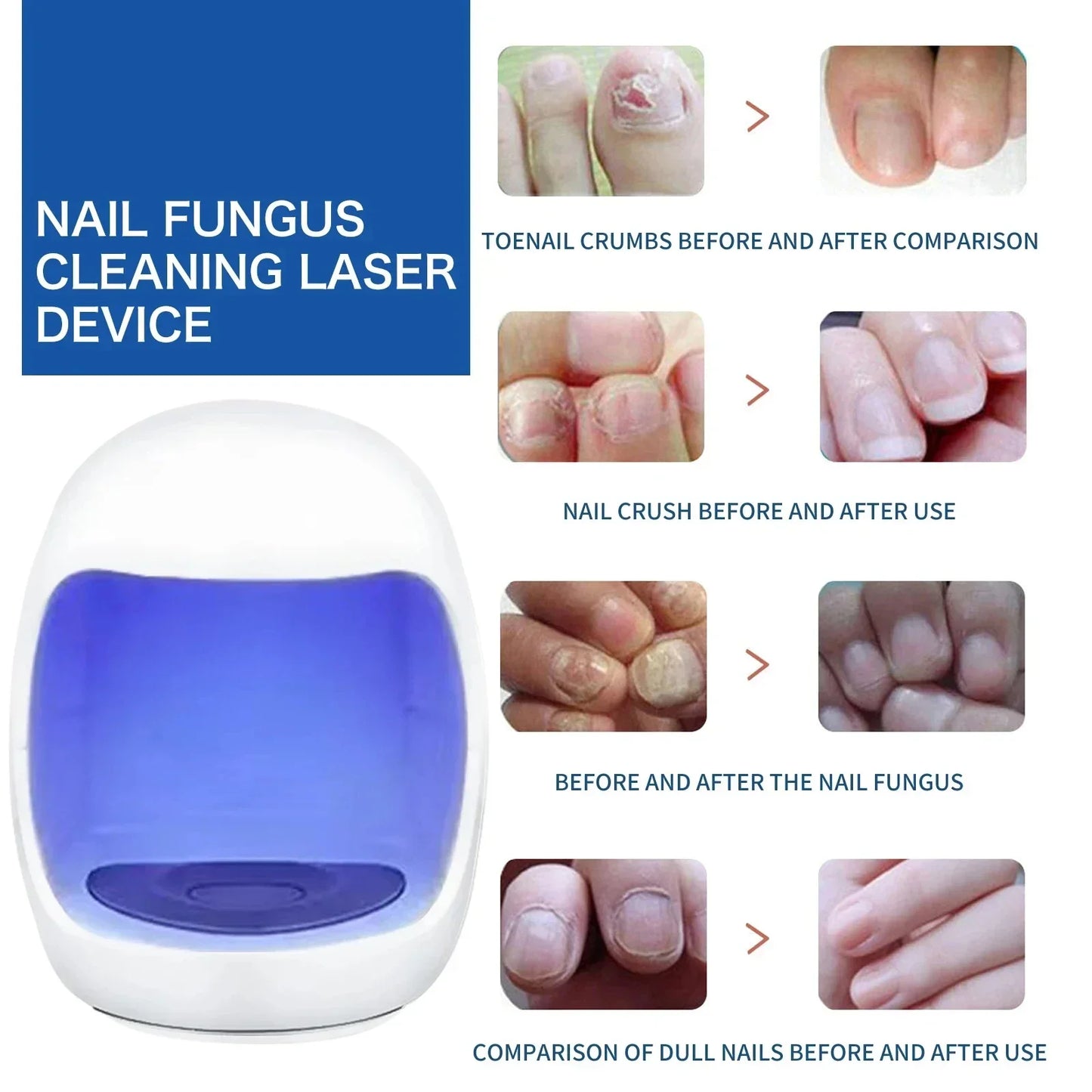 Fungal Nail Laser Device Repair Fast Onychomycosis Fungus Nails Toenail for Foot Nail Fungus Essential Oil Nail Treatment