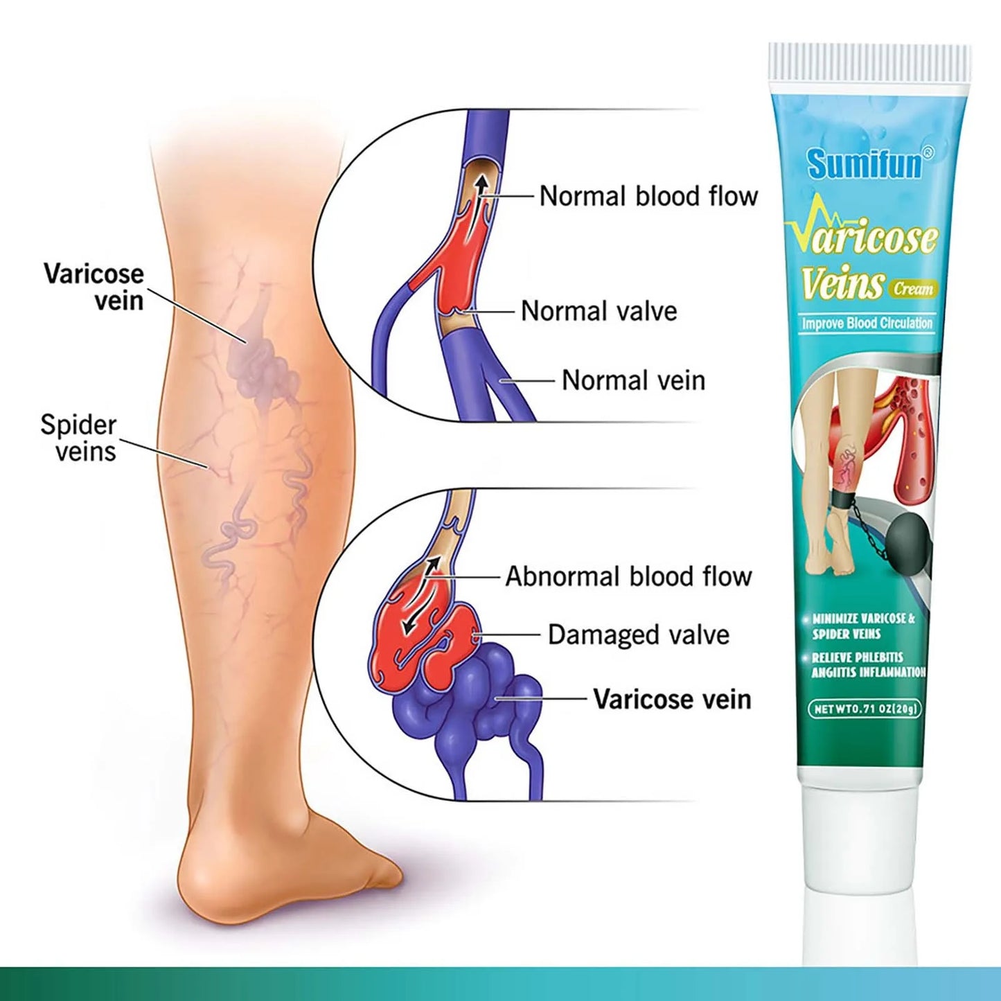 Varicose Vein Relief ,Improve Blood Circulations Spider Varicose Vein For Tired Heavy Legs Fast Relief Partijbenodigdheden
