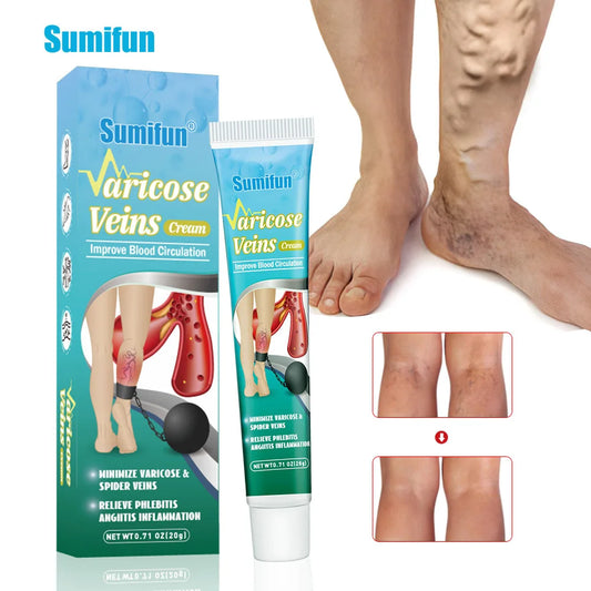 Varicose
