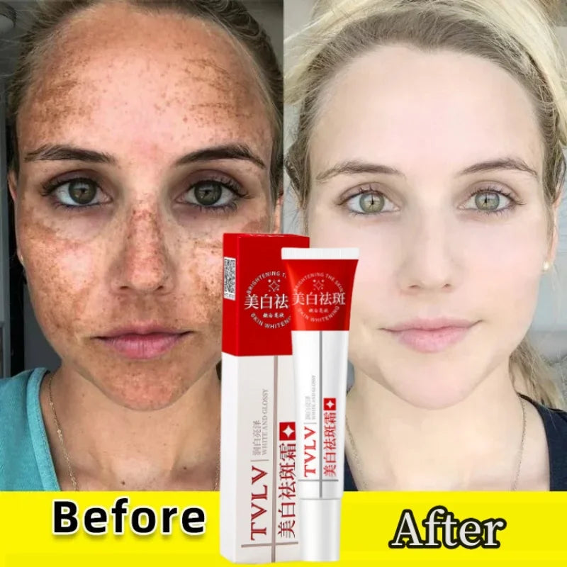 Whitening Freckle Cream Melasma Dark Spots Pigmentation Removal Products Fade Stain Melanin Repair Brighten Korean Skin Care
