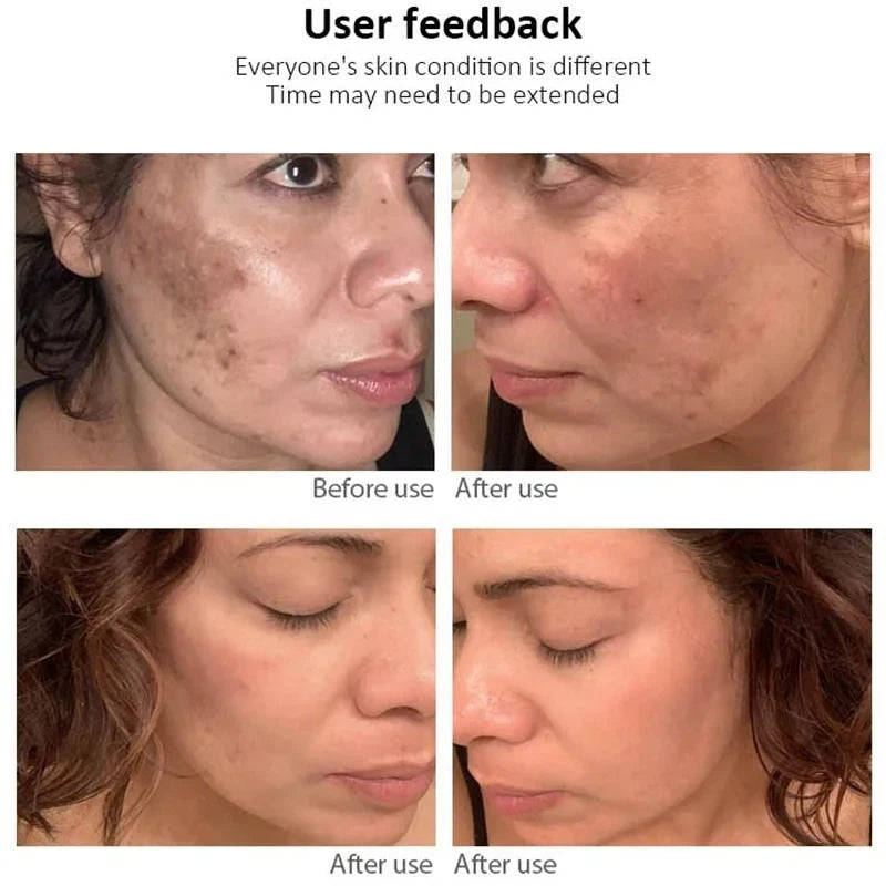 Whitening Freckle Cream Melasma Dark Spots Pigmentation Removal Products Fade Stain Melanin Repair Brighten Korean Skin Care