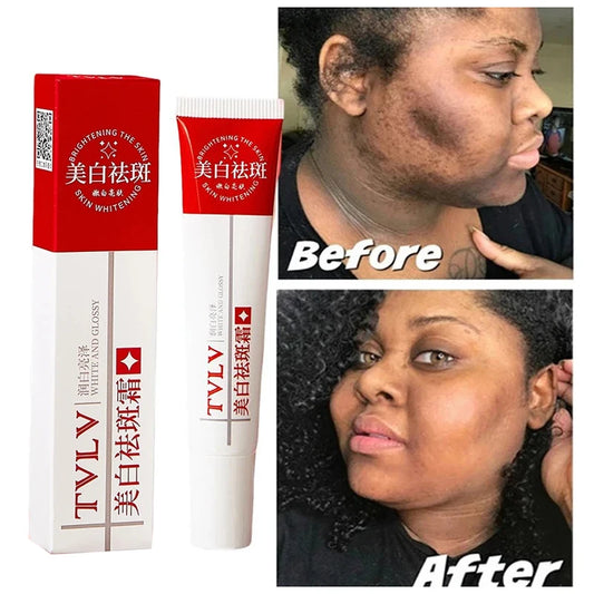 Whitening Freckle Cream Melasma Dark Spots Pigmentation Removal Products Fade Stain Melanin Repair Brighten Korean Skin Care