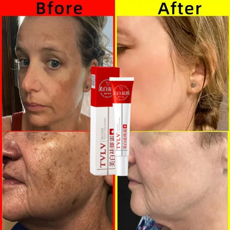 Whitening Freckle Cream Melasma Dark Spots Pigmentation Removal Products Fade Stain Melanin Repair Brighten Korean Skin Care