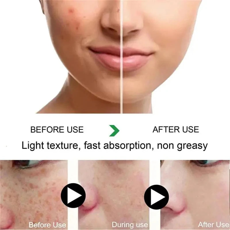 Whitening Freckle Cream Melasma Dark Spots Pigmentation Removal Products Fade Stain Melanin Repair Brighten Korean Skin Care
