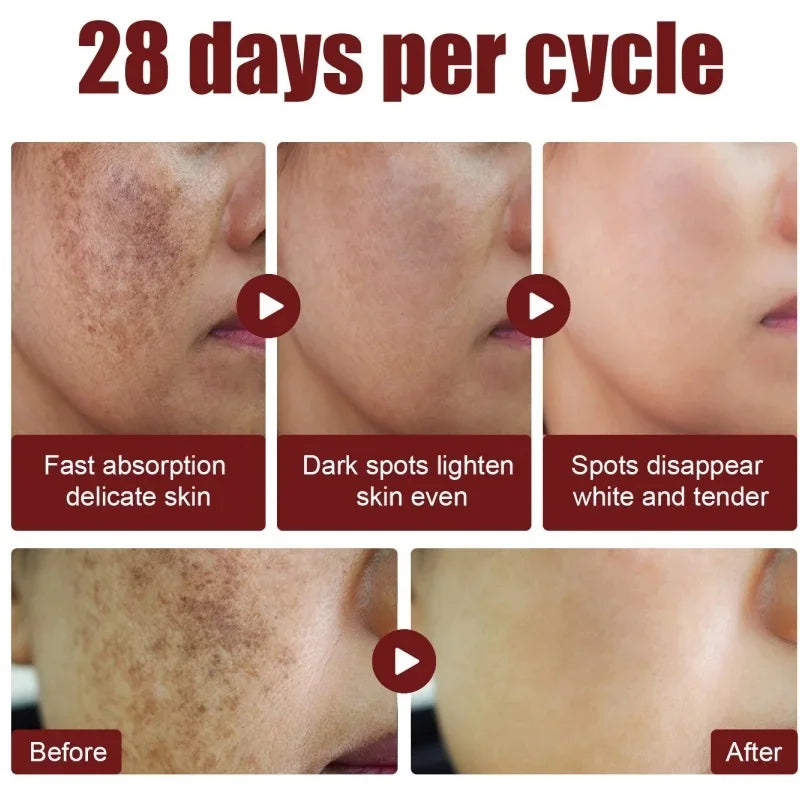 Whitening Freckle Cream Melasma Dark Spots Pigmentation Removal Products Fade Stain Melanin Repair Brighten Korean Skin Care
