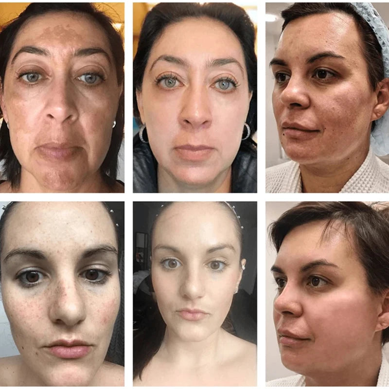 Whitening Freckle Cream Remove Melasma Dark Spots Lighten Remover Moisturizing Brightening Korean Skin Care