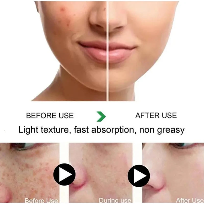 Whitening Freckle Cream Remove Melasma Dark Spots Lighten Remover Moisturizing Brightening Korean Skin Care