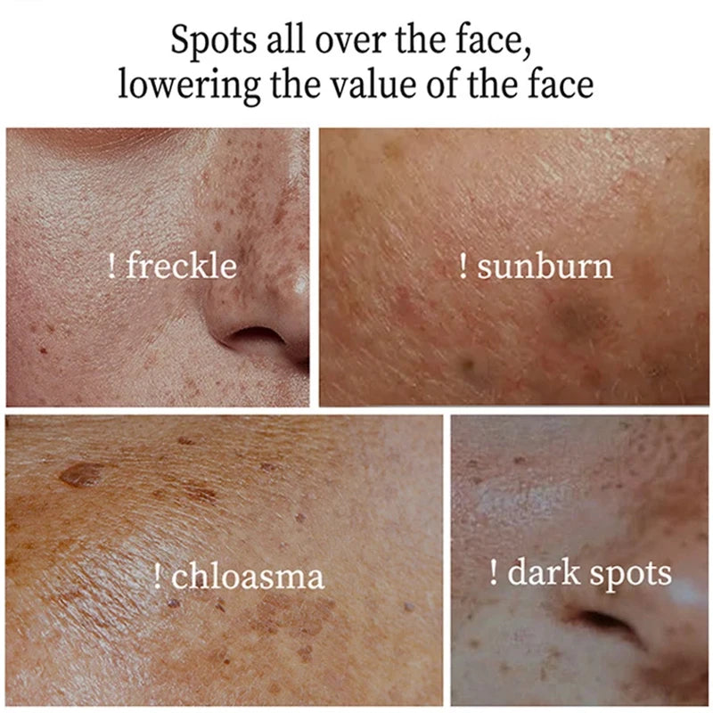 Whitening Freckle Cream Remove Melasma Dark Spots Pigmentation Fade Stain Melanin Repair Brighten Korean Skin Care  Products