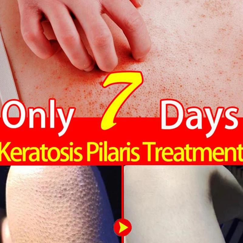 Body Scrub Mild Hair Follicle Keratinization Cream Removes Dead Skin Unblocks Pores Moisturizes Strawberry Legs Repairs Skin